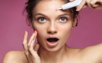 acne_scars-1