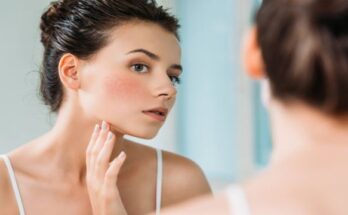 main_woman_w_flushed_skin