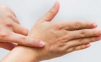 Hand_scar