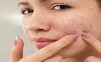 acne-Photo-istock-1