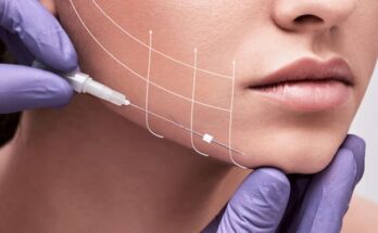 threadlifting