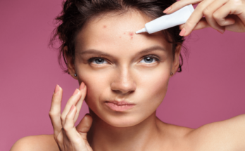Forehead acne
