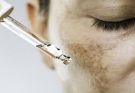 Ways to Get Rid of Hyperpigmentation